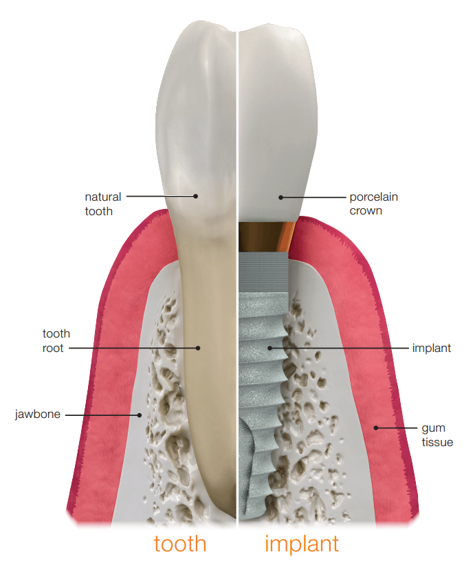 dental implants