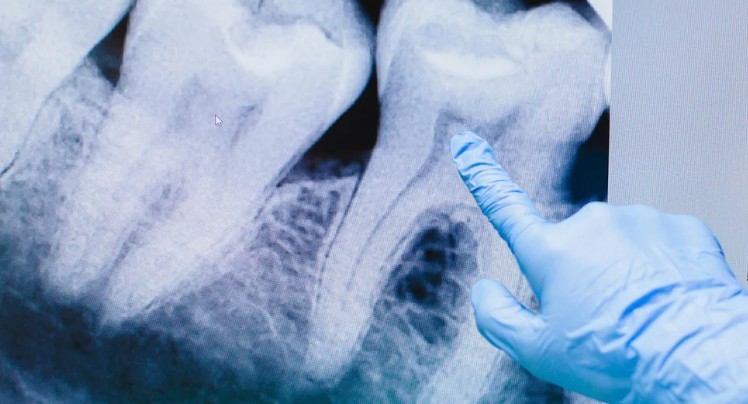 damaged tooth