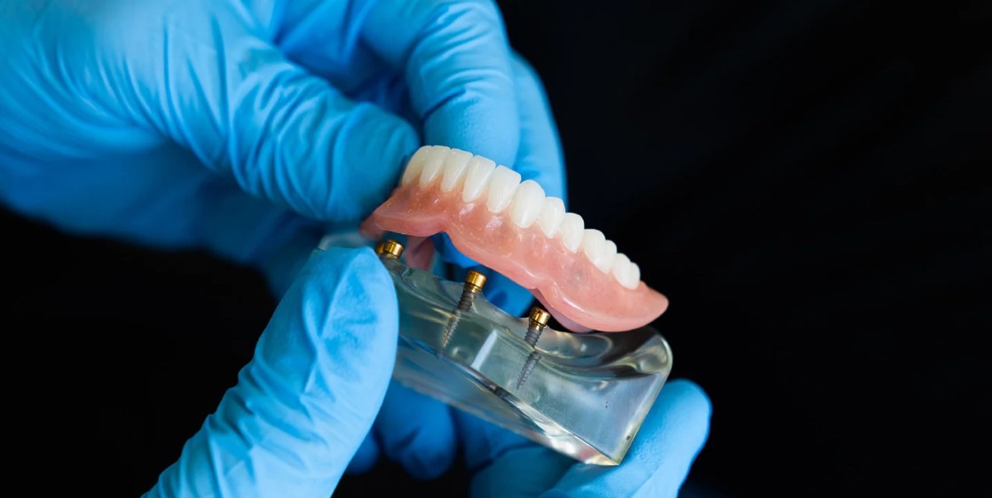 Veneers vs. Dental Bonding: Which Is Right for You?